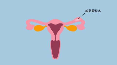 輸卵管積水能自然懷孕嗎？輸卵管積水如何懷孕？