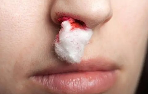 右鼻出血是什么原因引起的？右鼻出血警惕四種原因