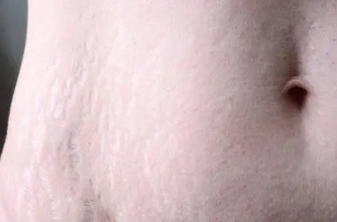 妊娠紋是什么原因引起的？避免妊娠紋的方法與技巧