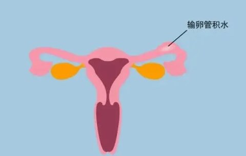 只有一側(cè)輸卵管還能正常懷孕嗎？少一根輸卵管的影響