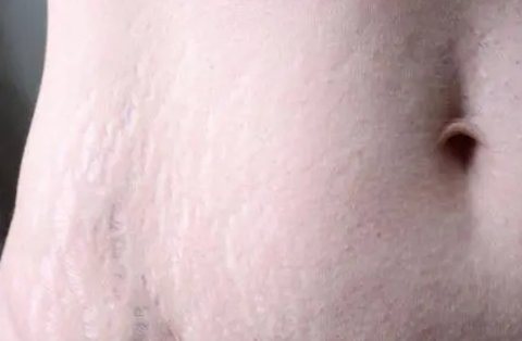妊娠紋好幾年了怎么淡化去除？多年的妊娠紋去除最好的辦法