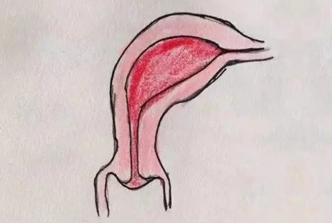 單角子宮能正常生育嗎？單角子宮對懷孕的影響