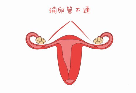 輸卵管極不通暢嚴(yán)重嗎？輸卵管極不通暢可以懷孕嗎？