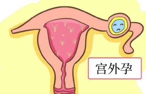 做試管會(huì)出現(xiàn)宮外孕嗎？試管嬰兒宮外孕的原因