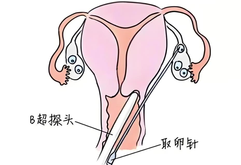 試管取卵針穿過子宮有影響嗎,試管取卵針會(huì)對子宮有傷害嗎