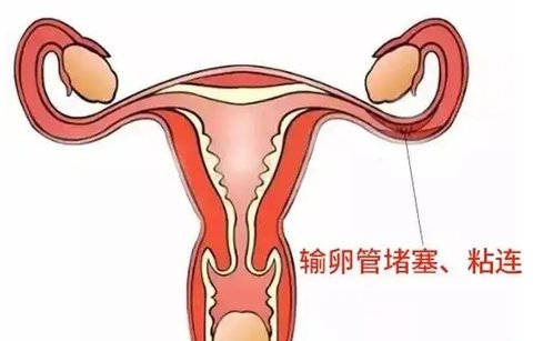 輸卵管粘連對試管有影響嗎？輸卵管粘連與試管嬰兒