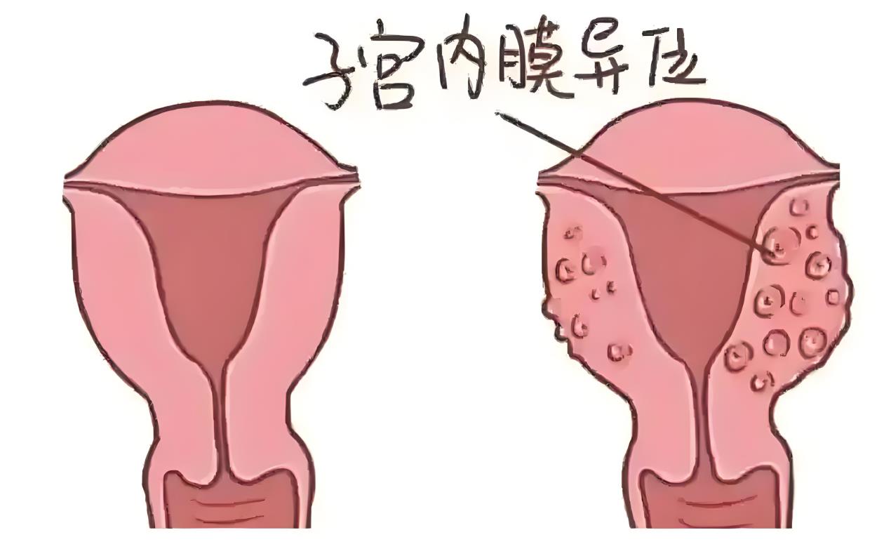 子宮內(nèi)膜異位 子宮內(nèi)膜異位