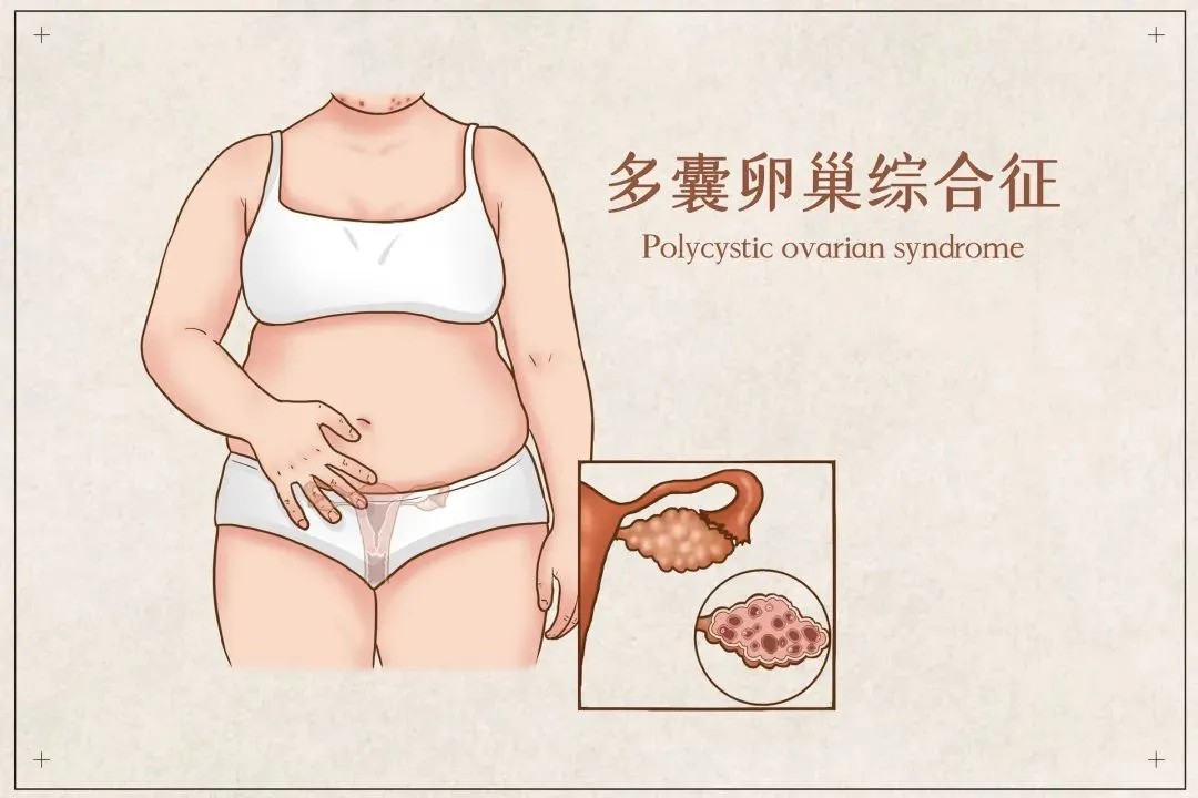 得了多囊卵巢綜合征該怎么吃？附醫(yī)學(xué)營(yíng)養(yǎng)治療方案！