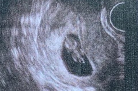 陰超可以檢查出哪些婦科疾病？陰超檢查疾病一覽